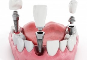 Методы имплантации зубов в современной стоматологии